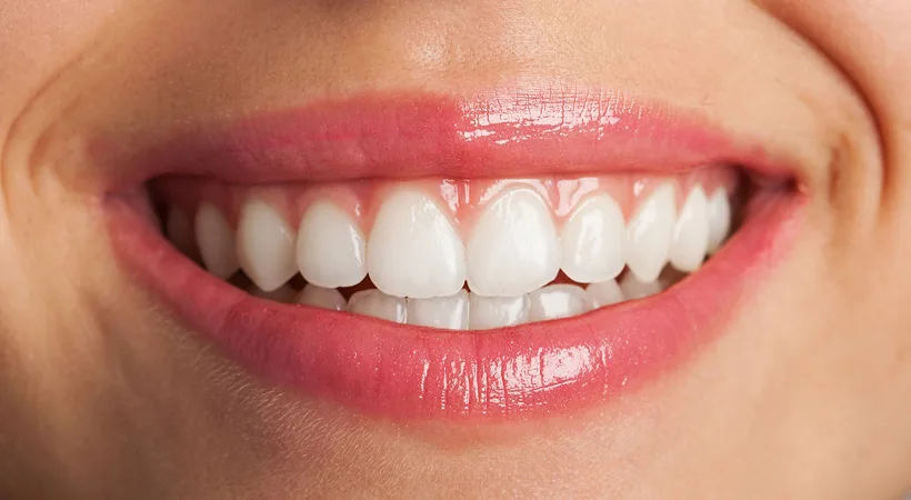 Teeth Whitening Options: Which One is Best for You?